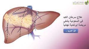 اعراض سرطان الكبد الحميد، وعلاجها بطريقة سهل 14390 1