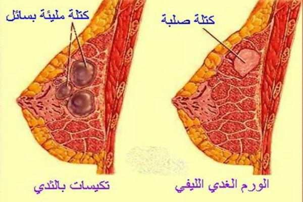 التهاب الثدي , بعض المعلومات عن التهابات الثدي , 