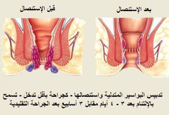 علاج الناسور - افضل ادوية لعلاج الناسور بدون جراحة 466 2