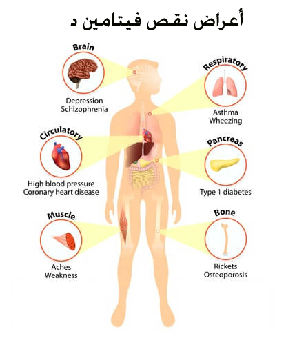اعراض نقص فيتامين د , فيتامين د واهميته واعراض نقصه