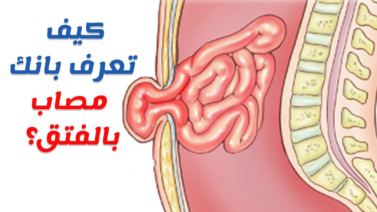 علاج الفتق عند الرجال 10259