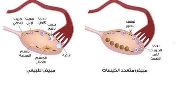 ماهي اعراض تكيس المبايض - اهم اعراض تكيس المبايض 2594