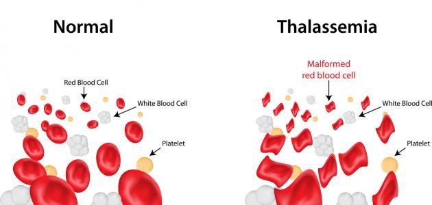 مرض الثلاسيميا - اعراض امراض الثلاسيميا 5456 3