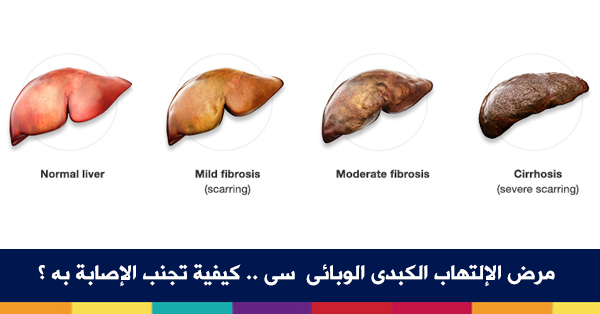 مرض الكبد الوبائي , اهم المعلومات حول مرض الكبد الوبائي