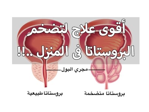 علاج تضخم البروستاتا , مرض تضخم البروستاتا