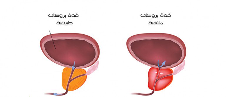 اسباب تضخم البروستاتا - امراض الذكورة لدى الرجال 410 3