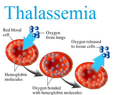 مرض الثلاسيميا - اعراض امراض الثلاسيميا 5456 2