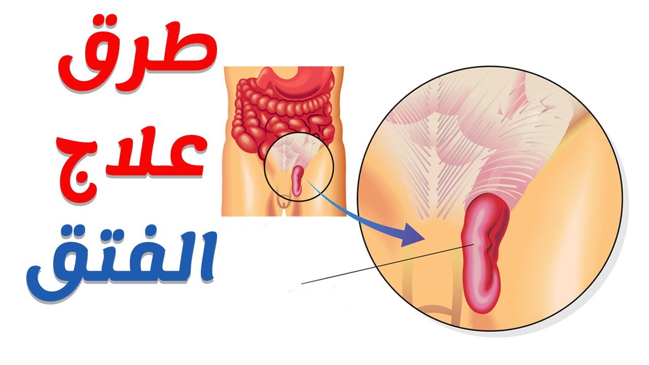 علاج الفتق عند الرجال 10259 2