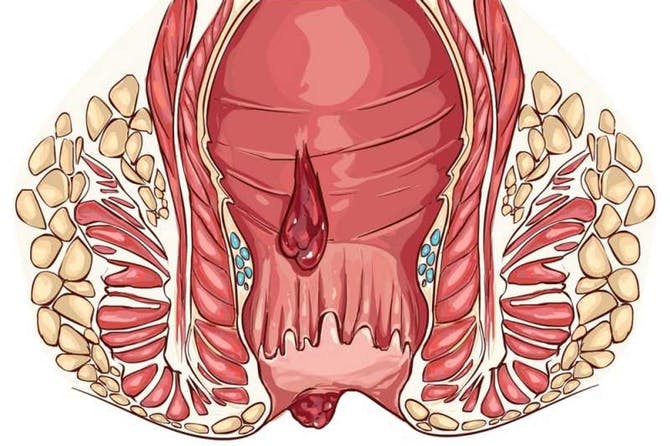 اسباب البواسير - القضاء على البواسير بالمنزل في دقائق 336