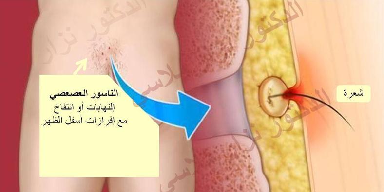 علاج الناسور , افضل ادوية لعلاج الناسور بدون جراحة