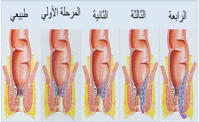 علاج الناسور - افضل ادوية لعلاج الناسور بدون جراحة 466 1