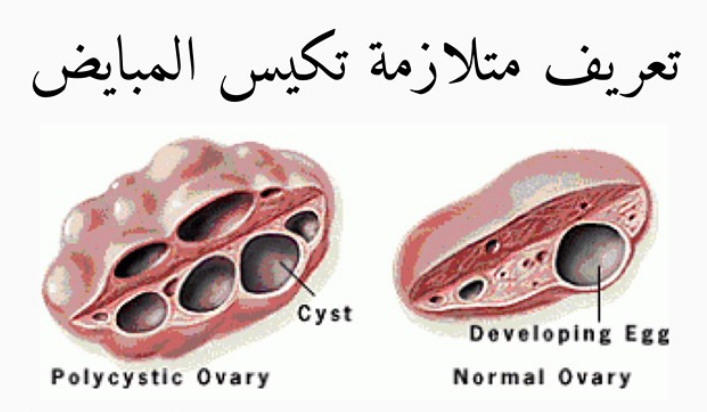 ماهي اعراض تكيس المبايض - اهم اعراض تكيس المبايض 2594