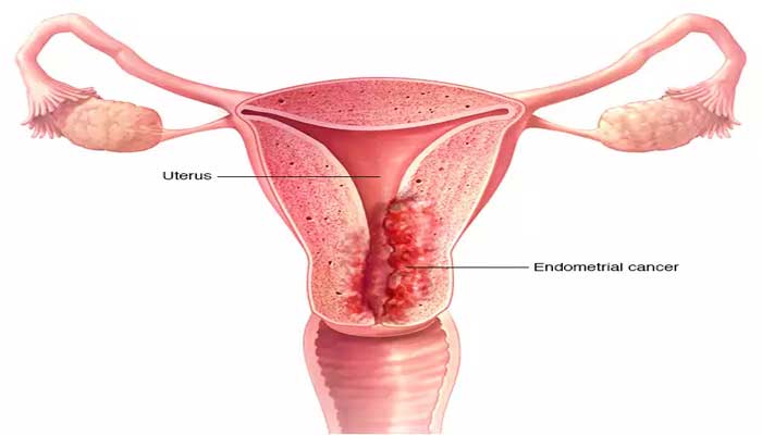 اعراض سرطان الرحم , اهم واخطر الاعراض لسرطان الرحم