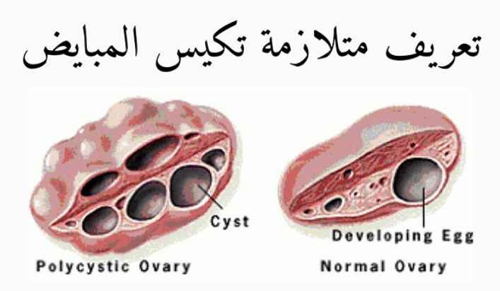 Поликистозные яичники лечение. Синдром поликистозных яичников (PCOS. Поликистозная морфология яичников.