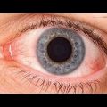 4831 4 علاج حساسية العين - تخلص مما يؤلم عينيك بافضل العلاجات المجرب تركي منجد