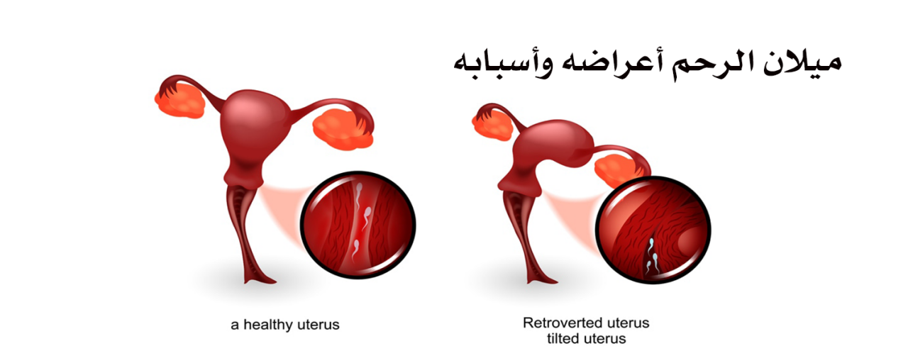 الرحم المقلوب والولادة 10487